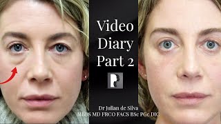 Blepharoplasty Video Diary  Day 2 After Surgery 2 of 15 [upl. by Eilrahc]