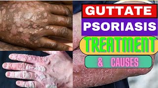 How to cure GUTTATE PSORIASIS CAUSES OF PSORIASIS TREATMENT PHOTOTHERAPY DERMATOLOGY AUTOIMMUNE [upl. by Jordain]