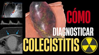 COLECISTITIS  HALLAZGOS POR IMAGEN  USGTACRMHIDA [upl. by Neenaj]