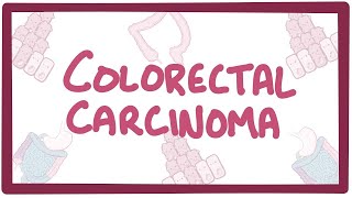 Colorectal carcinoma  causes symptoms diagnosis treatment pathology [upl. by Dnalyr416]