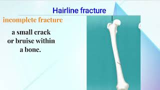 Types Of Fractures  Bone  Orthopedic  orthopedics ms fcps doctor fracture [upl. by Denzil]