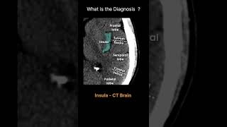 Insula  CT Brain CT Brain Anatomy Grey matter structures Quiz 25radiologychannel007 [upl. by Vihs]