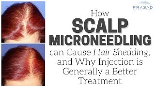 How Scalp Microneedling can Cause Temporary Hair Shedding and Advantages of Injection Treatment [upl. by Oinafipe]