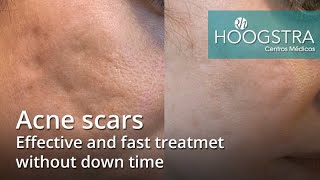 Acne scars  Effective and fast treatmet without down time 22024 [upl. by Niwrehs]