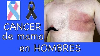 Cáncer de mama en Hombres [upl. by Hosfmann]