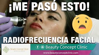 🥺😱 ME HICE RADIOFRECUENCIA facial luego de la Bichectomía ¡Y me pasó ESTO [upl. by Shultz]