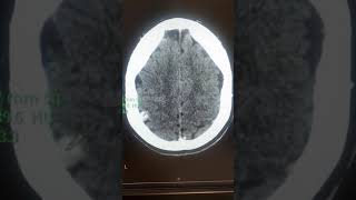 meningioma ctscan [upl. by Bettzel951]