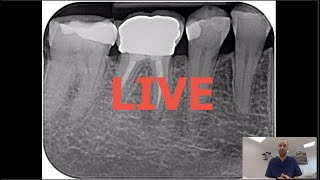 Commentaires LIVE  Retraitement endodontique  46 couronne tenons fibrés condensation verticale [upl. by Olimac]