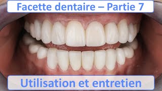 Facette dentaire  Utilisation et Entretien  Guide complet  Partie 7 [upl. by Sabsay]