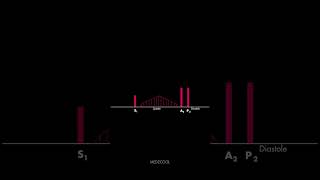 Atrial Septal Defect Heart Sound [upl. by Risa]