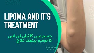 Lipoma  giltiyan  Homeo Treatment in Urdu Hindi  Dr M Salman [upl. by Eyla]