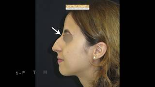 Rhinoplastie médicale Rhinoplastie sans chirurgie  Dr Vincent Nguyen [upl. by Lightman]