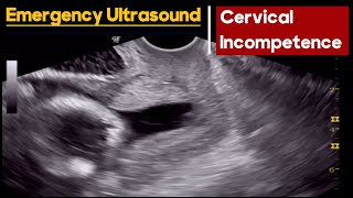 Cervical Incompetence  How to Diagnose  Abdominal vs TVS Ultrasound [upl. by Bruns907]