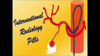 Percutaneous drainage of a thoracic fluid collection [upl. by Motch]