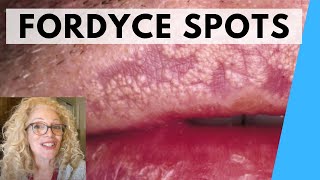 SYRINGOMA VS FORDYCE SPOTS  NATURAL REMEDIES [upl. by Bullis848]