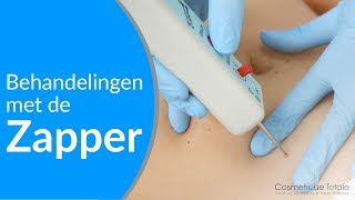 Fibromen en ouderdomswratjes verwijderen met de Zapper [upl. by Fabiola]