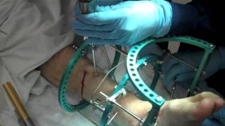 Removal of External Fixation [upl. by Piper]