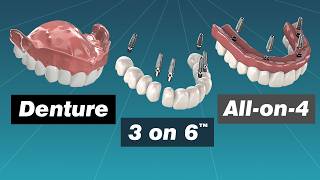 Alternative to Dentures Comparing Dentures Overdentures Allon4 and 3 on 6™ [upl. by Loralie859]