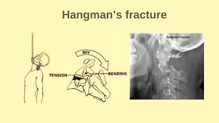 Hangmans Fracture C2 fracture Cervical spine fracture [upl. by Galatia245]