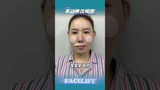 Is it possible to have high cheekbones without undergoing bone reconstruction fyp facelift viral [upl. by Anauq]