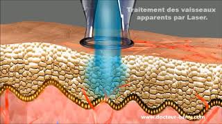 Le traitement de la couperose au laser  Dr Barry [upl. by Henryson]