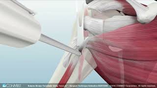 Biceps Tenodesis Using TenoLok® [upl. by Agnimod]