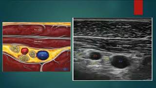 Upper Limb Blocks Infraclavicular amp Axillary Brachial Plexus Blocks [upl. by Jago823]