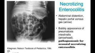 Necrotizing enterocolitis2 [upl. by Belamy]