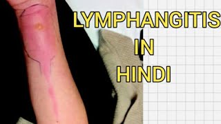 Acuteamp chronic lymphagitis in hindi  Cause  symptom [upl. by Us237]