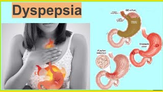 Dyspepsia  Functional Dyspepsia  Organic Dyspepsia Heart Burn Hindi  UrduTडिस्पेप्सिया [upl. by Eylsel]