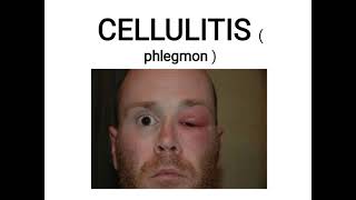 cellulitis [upl. by Kurt622]