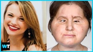 You Won’t Believe Katie Stubblefield’s Historic FACE TRANSPLANT [upl. by Arammat799]