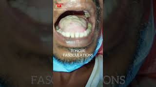 Tongue Fasciculations  Motor Neuron Disease  Dr Shankar Dey [upl. by Steve93]