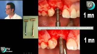 Implants Dentaires  Lexpansion osseuse par le Dr Thierry BRINCAT  GI TV [upl. by Cherilyn748]