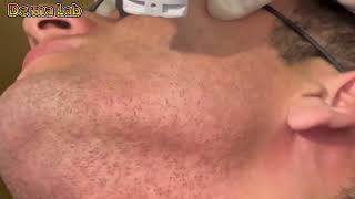 Permanent Hair removal treatment dermalab hairremoval dermatology skincare gentlelase gentlel [upl. by Apoor501]