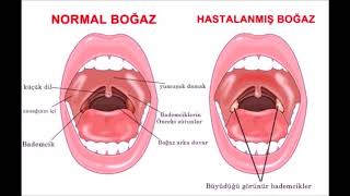 Boğaz Ağrısı Neden Nasıl Olur Nedenleri Tehlikeli midir [upl. by Gabriel622]