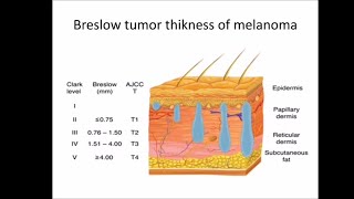 Melanoma [upl. by Idell]