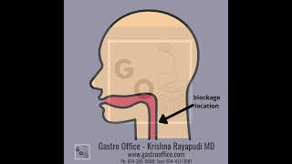 Hypopharynx stricture dysphagia  needle knife [upl. by Harpole735]