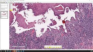 Pemphigus foliaceus and pemphigus vulgaris [upl. by Ellord]