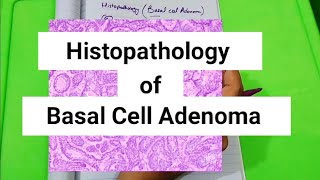 Histopathology of Basal cell Adenoma Monomorphic Adenoma [upl. by Gnek]