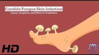 Candida Fungus Skin Infection Explained What You Need to Know [upl. by Kcirad173]