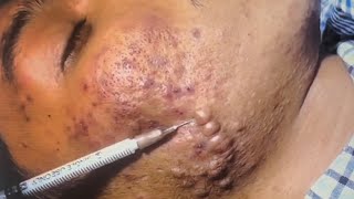 Big Cystic Acne Blackheads in Cambodia [upl. by Elwina]