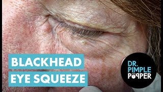 Blackhead Eye Squeeze [upl. by Norabal]