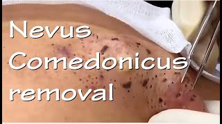 Nevus Comedonicus removal  Video 3 of 3 The ultimate quotblackheadquot removal video [upl. by Anailuy]