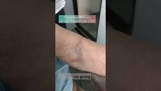 A case of Phlebitis Treated with Homeopathy  Case results drshrutikadhavane homeopathy [upl. by Oilalue917]