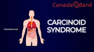 Carcinoid Syndrome [upl. by Zilada]