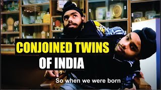 India Conjoined Twins that Refused to be Separated [upl. by Olinde465]