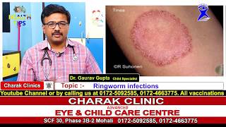 Ringworm Infections in children  why does it happen and how to prevent and treat it [upl. by Haron865]