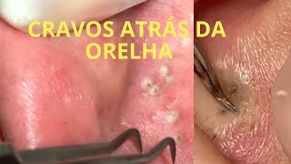 cravos atrás da orelha  耳の後ろのにきび  귀 뒤에 여드름 [upl. by Fiona]