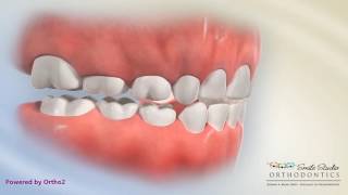 Anterior Crossbite Functional Shift [upl. by Benenson]